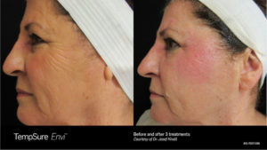 TempSure® Envi