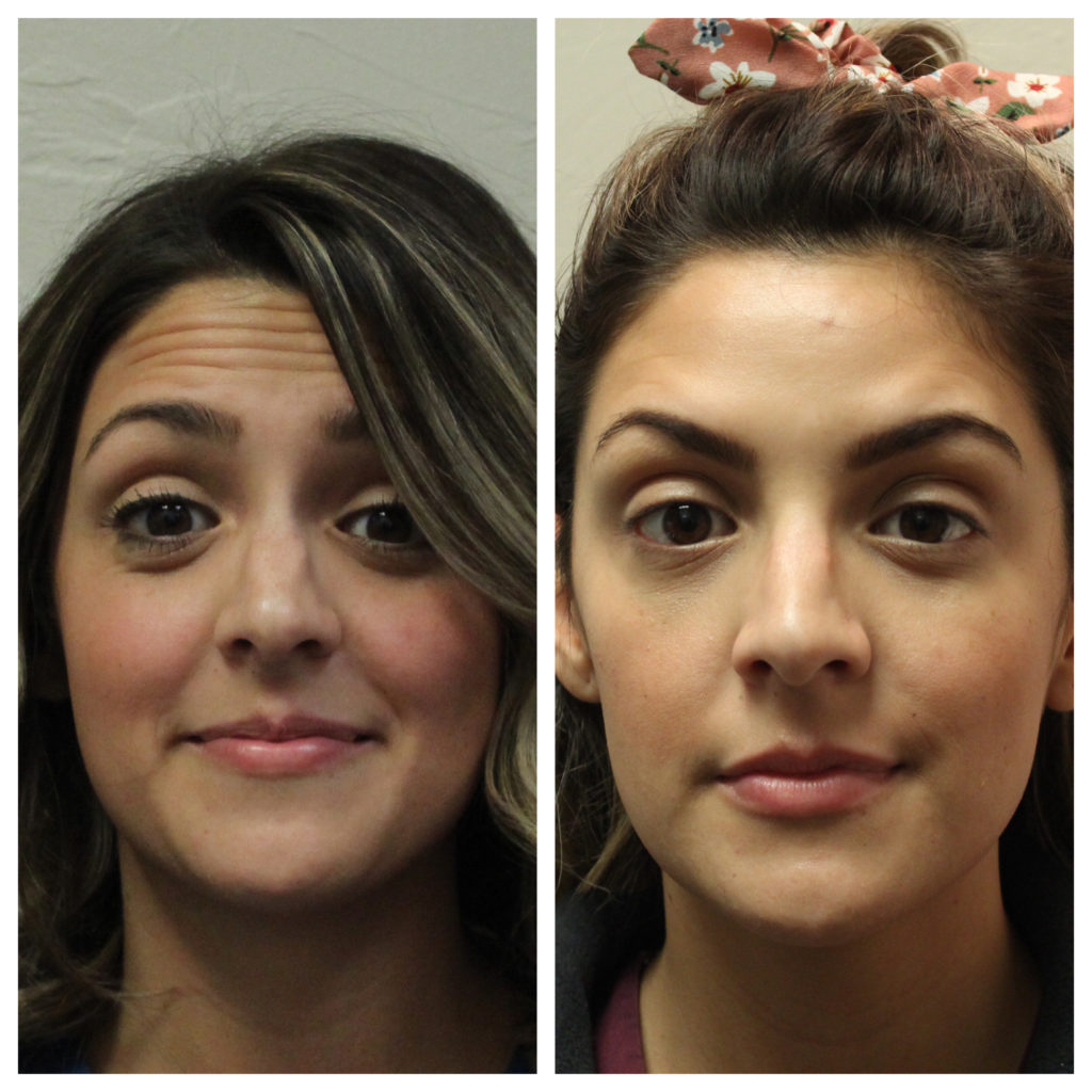 Botox