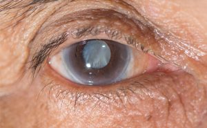 Discussing treatment options for dry eyes is important for our Laguna Hills, CA patients